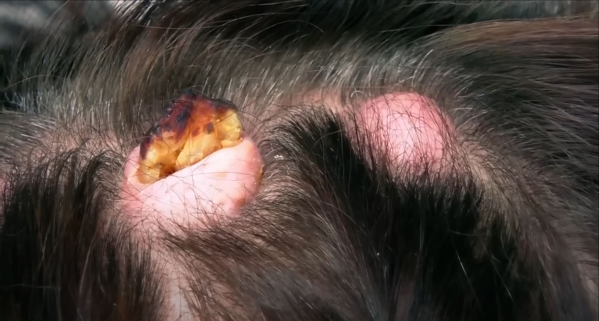 Dr Lee treats a patient who has multiple bumps all over her head, suspected to be pilar cysts. One of these growths has ruptured, causing it to grow into a horn-like protrusion.