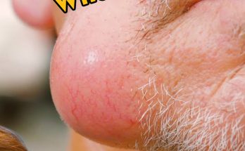 25 Causes of Raised Skin Bumps (with Pictures & Video)