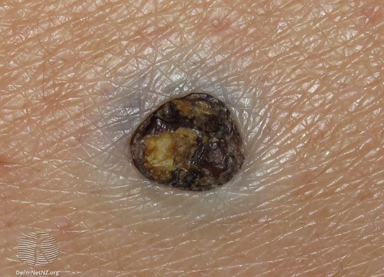 Dilated Pore of Winer: Picture, Causes, Treatment, and Prevention