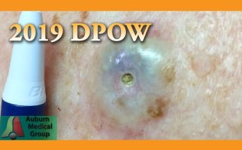 Dilated Pore of Winer