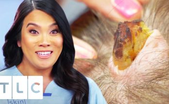 Removing A Horn-Like Growth And 6 Cysts From Woman's Head | Dr. Pimple Popper