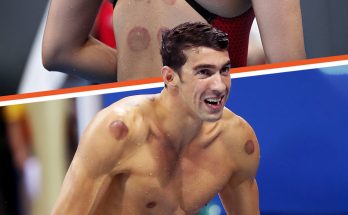 WHY SOME OF THE OLYMPIC ATHLETES HAVE LARGE CIRCULAR BRUISES ON THEIR SKIN? 😱 Ever spotted those dark red circles on Olympic athletes' backs? Yep, Michael Phelps was rocking those spots at the 2016 Rio Olympics. 😰 Stars such as Jennifer Aniston & Gwyneth Paltrow showed similar signs on their skin. What it is in the comments.👇