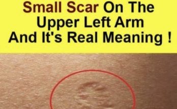 Smallpox vaccine scars: What they look like and why