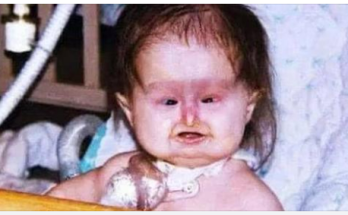 Unusual Syndrome at Birth: 22 Years Later