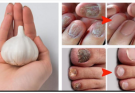 Erase Nail Fungus Naturally: Discover the Power of Garlic 