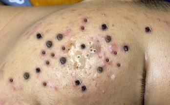 What do blackheads look like?