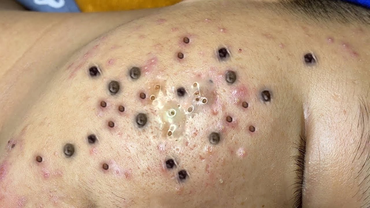 What do blackheads look like?