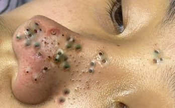 Whiteheads vs. Blackheads: Causes, Treatments, and Tips