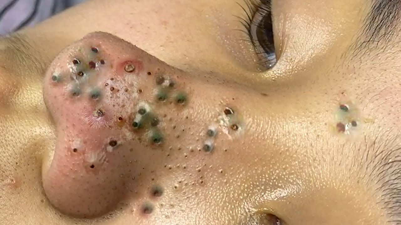 Whiteheads vs. Blackheads: Causes, Treatments, and Tips