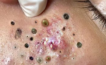 Blackheads: What They Look Like, Treatment & Prevention