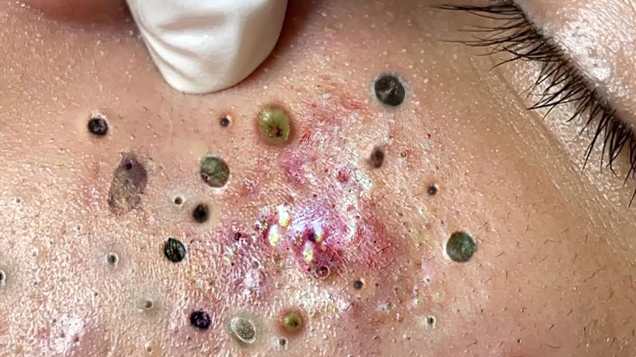 Blackheads: What They Look Like, Treatment & Prevention