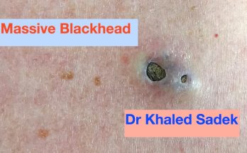 Massive 3 year old Blackhead finally comes out. Dr Khaled Sadek