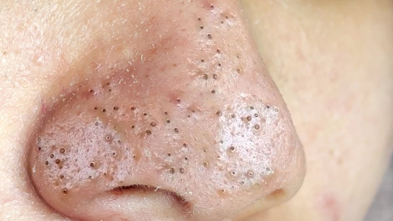 How To Get Rid of (and Prevent) Blackheads: 10 Solutions (Video)