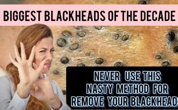 The science on deep blackheads and how to banish them for good