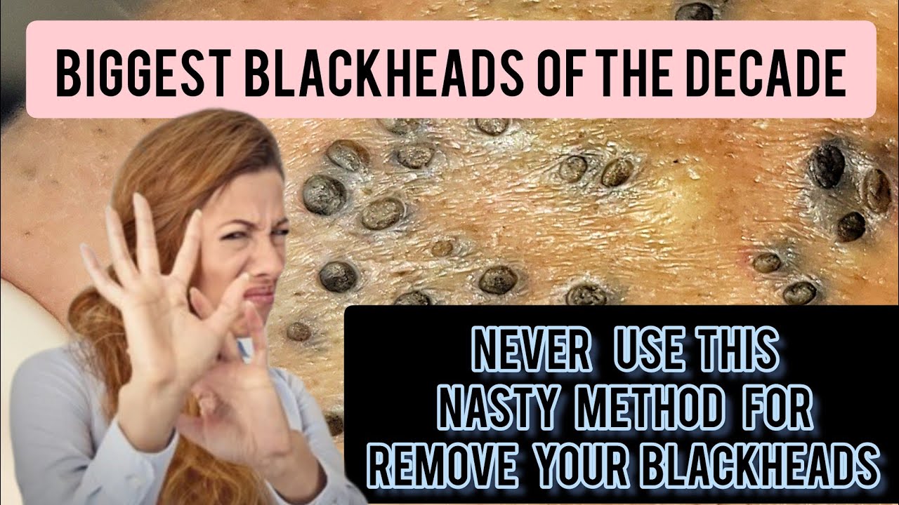 The science on deep blackheads and how to banish them for good