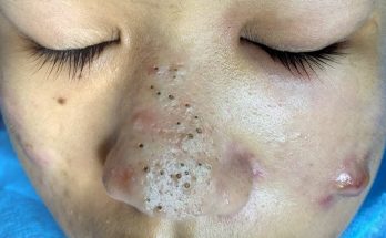 How To Get Rid of (and Prevent) Blackheads: 10 Solutions