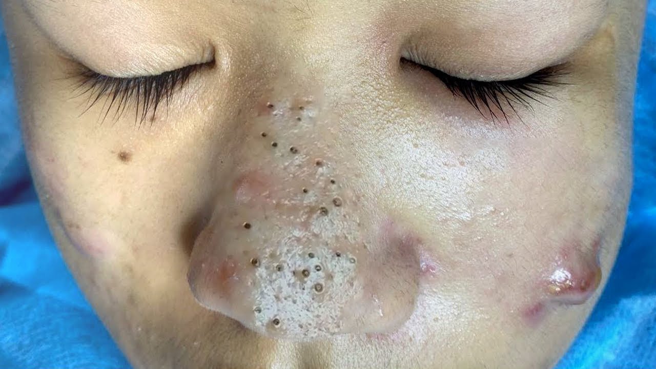 How To Get Rid of (and Prevent) Blackheads: 10 Solutions