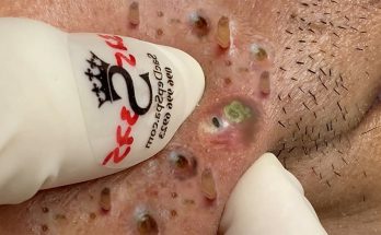 Whiteheads vs. Blackheads: Causes, Tips, and More