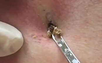 Massive Monster Blackhead in Ear Removal 2024