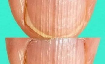 Having Striped Nails Could Mean That Your Body Is… Read More