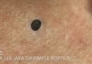 Deep DPOW extraction - Dilated Pore of Winer extraction - ChangYing Spa