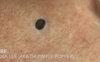 Deep DPOW extraction - Dilated Pore of Winer extraction - ChangYing Spa