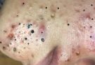 Blackhead Removal Results You Need to See!