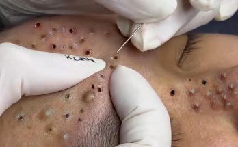 GIANT blackhead removal!