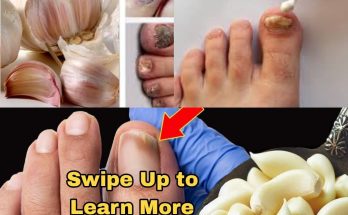 The Ultimate Nail Fungus Killer: A Natural Remedy That Works Fast