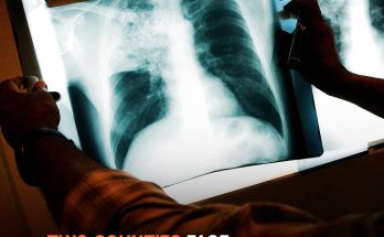 Kansas Tuberculosis Outbreak, Largest in US History, Hits 67 Active Cases Across Two Counties – Latest Details