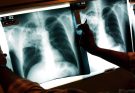 Kansas Tuberculosis Outbreak, Largest in US History, Hits 67 Active Cases Across Two Counties – Latest Details