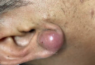 TREATMENT OF PIMPLES (ABSCESSES IN THE EAR AREA) IS COMMITTED TO NOT RECURRING, NOT LEAVING SCARS 