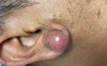 TREATMENT OF PIMPLES (ABSCESSES IN THE EAR AREA) IS COMMITTED TO NOT RECURRING, NOT LEAVING SCARS 