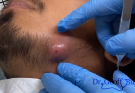 TREATMENT Infected Cyst Drainage on Jawline IS COMMITTED TO NOT RECURRING, NOT LEAVING SCARS