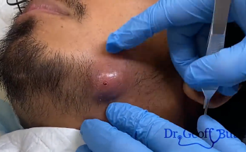 TREATMENT Infected Cyst Drainage on Jawline IS COMMITTED TO NOT RECURRING, NOT LEAVING SCARS