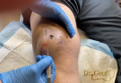 TREATMENT Removal of drainage of a knee hematoma COMMITTED TO NOT RECURRING, NOT LEAVING SCARS