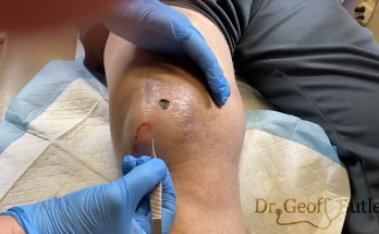 TREATMENT Removal of drainage of a knee hematoma COMMITTED TO NOT RECURRING, NOT LEAVING SCARS