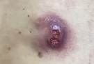 TREATMENT OF Drainage of an infected cyst COMMITTED TO NOT RECURRING, NOT LEAVING SCARS