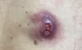 TREATMENT OF Drainage of an infected cyst COMMITTED TO NOT RECURRING, NOT LEAVING SCARS