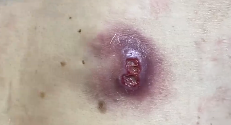 TREATMENT OF Drainage of an infected cyst COMMITTED TO NOT RECURRING, NOT LEAVING SCARS