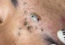 Summarize What is blackheads? How to remove, prevention and treatment