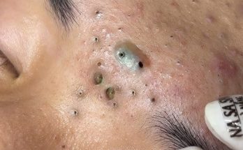 Summarize What is blackheads? How to remove, prevention and treatment