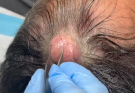 TREATMENT OF Removal of a decent sized pilar cyst on the scalpCOMMITTED TO NOT RECURRING, NOT LEAVING SCARS