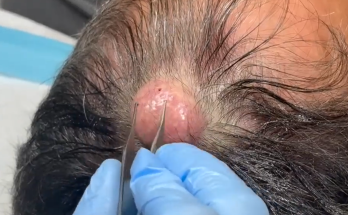 TREATMENT OF Removal of a decent sized pilar cyst on the scalpCOMMITTED TO NOT RECURRING, NOT LEAVING SCARS