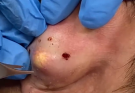 Removal of the ear's epidermal cyst with a commitment to prevent recurrence and scarring