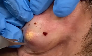 Removal of the ear's epidermal cyst with a commitment to prevent recurrence and scarring