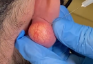 Removal of an epidermal cyst on the earlobe with a commitment to prevent recurrence and leave scars