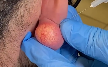 Removal of an epidermal cyst on the earlobe with a commitment to prevent recurrence and leave scars