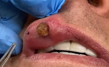 TREATMENT Removal of Removal of a pyogenic granuloma on the lipIS COMMITTED TO NOT RECURRING, NOT LEAVING SCARS