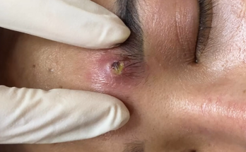 Squeezing abscesses in the eyebrow area, guaranteed not to recur - not leaving scars.